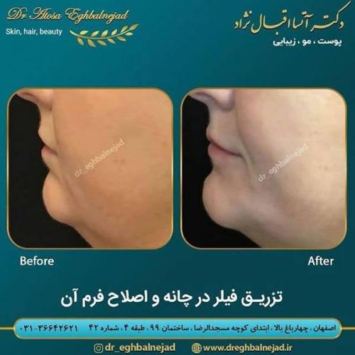 تزریق-فیلر-در-چانه-و-اصلاح-فرم-آن