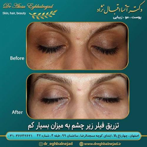 تزریق-فیلر-زیر-چشم-2