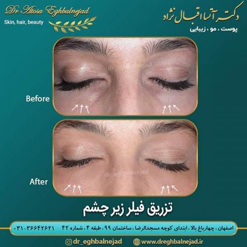 تزریق-فیلر-زیر-چشم-5