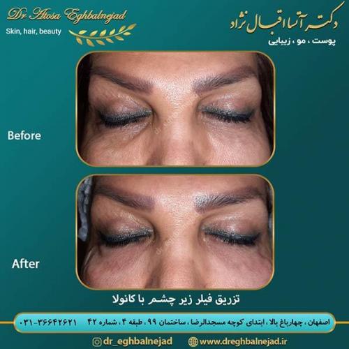 تزریق-فیلر-زیر-چشم-با-کانولا