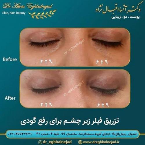 تزریق-فیلر-زیر-چشم-برای-رفع-گودی-20