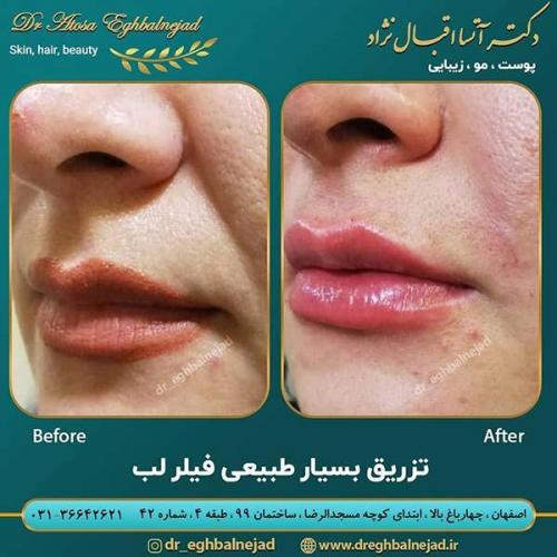 تزریق-فیلر-لب-1