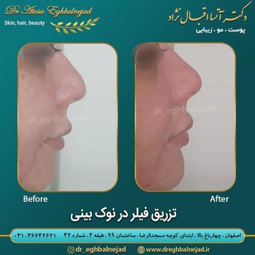 تزریق-فیلر-نوک-بینی