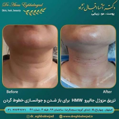 تزریق-مزوژل-جالپرو-برای-باز-شدن-خطوط-گردن