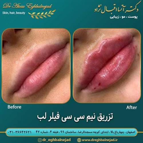 تزریق-نیم-سی-سی-فیلر-لب-1