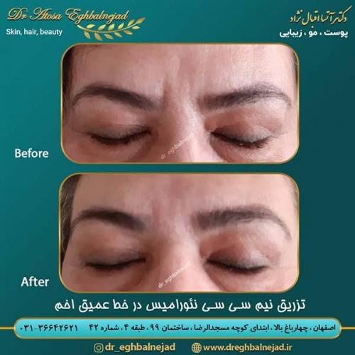 تزریق-نیم-سی-سی-نئورامیس-در-خط-عمیق-اخم
