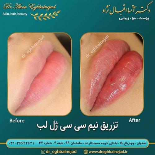 تزریق-نیم-سی-سی-ژل-لب