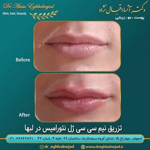 تزریق-نیم-سی-سی-ژل-نئورامیس-در-لبها