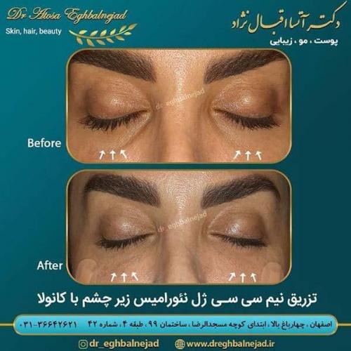 تزریق-نیم-سی-سی-ژل-نئورامیس-زیر-چشم-با-کانولا