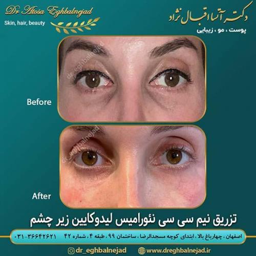 تزریق-نیم-سی-سی-ژل-نئورامیس-لیدوکایین-زیر-چشم