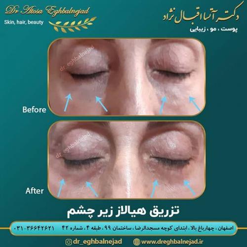 تزریق-هیالاز-1