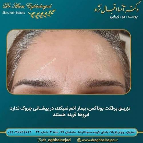 تزریق-پرفکت-بوتاکس