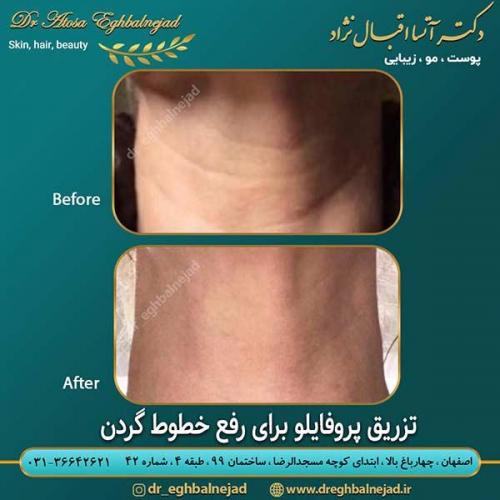 تزریق-پروفایلو-برای-رفع-خطوط-گردن