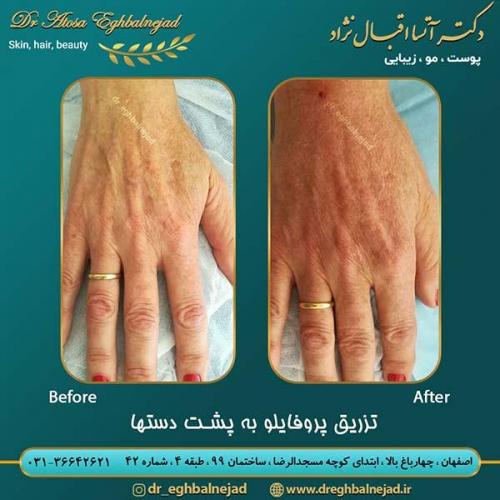 تزریق-پروفایلو-به-پشت-دست-ها