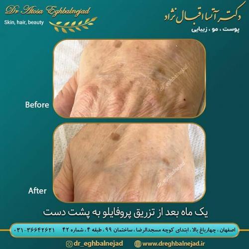 تزریق-پروفایلو-به-پشت-دست