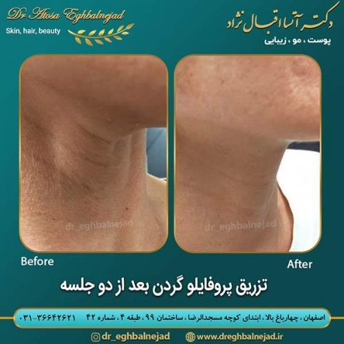 تزریق-پروفایلو-گردن