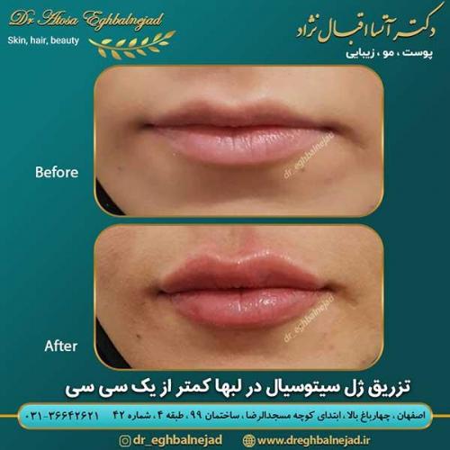 تزریق-ژل-3