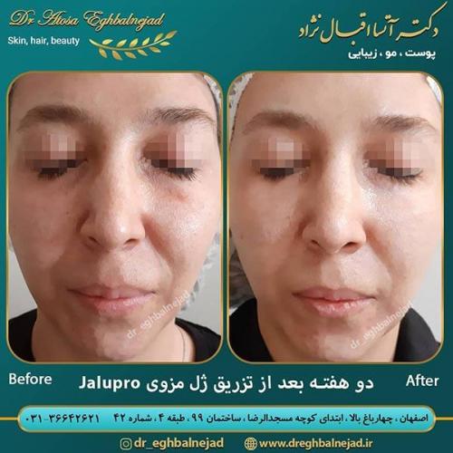 تزریق-ژل-6