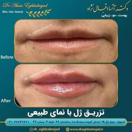 تزریق-ژل-با-نمای-طبیعی
