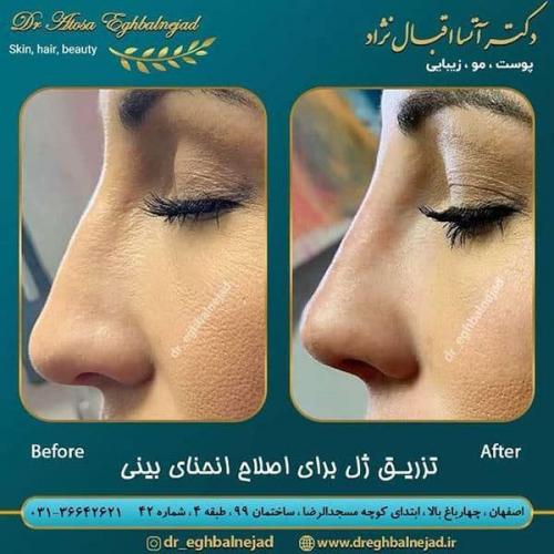 تزریق-ژل-برای-اصلاح-انحنای-بینی