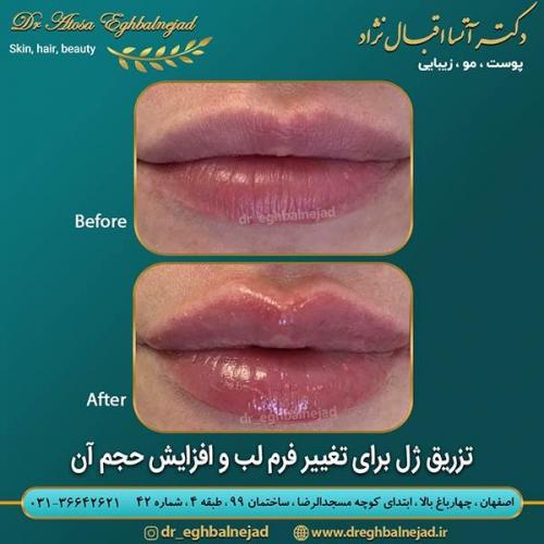 تزریق-ژل-برای-تغییر-فرم-لب-و-افزایش-حجم