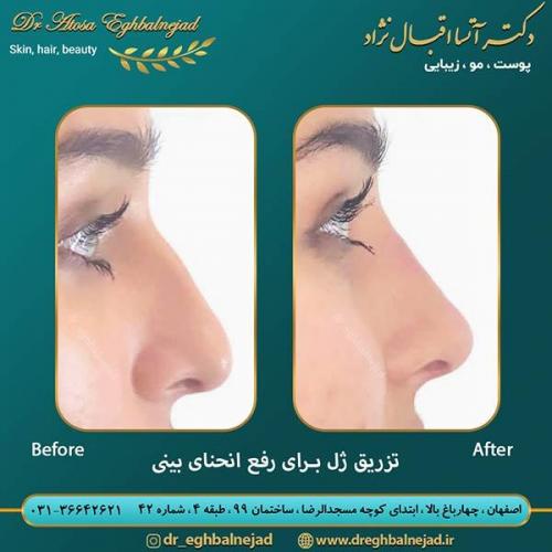 تزریق-ژل-برای-رفع-انحنای-بینی