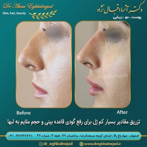 تزریق-ژل-به-بینی-و-لب-ها