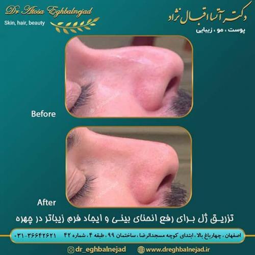 تزریق-ژل-بینی