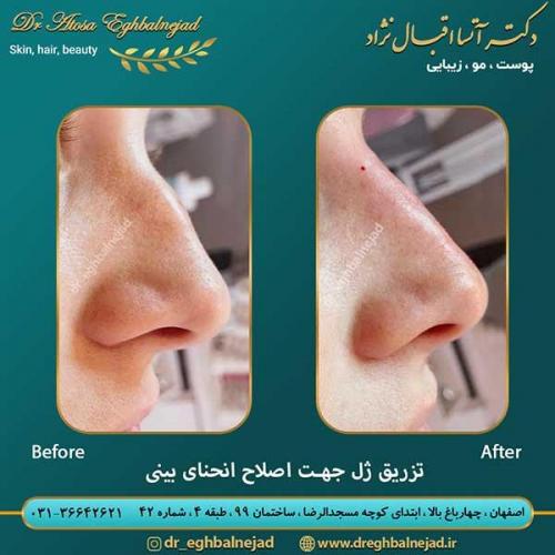 تزریق-ژل-جهت-اصلاح-انحنای-بینی