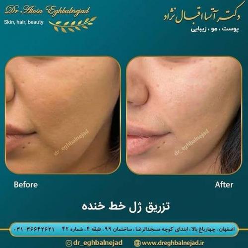 تزریق-ژل-خط-خنده-20