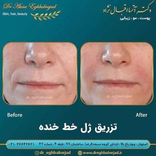 تزریق-ژل-خط-خنده-21