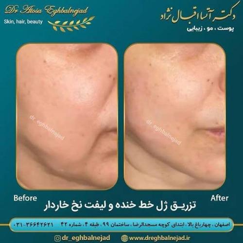 تزریق-ژل-خط-خنده-و-لیفت-نخ-خاردار