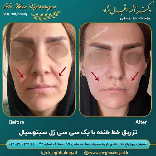 تزریق-ژل-خط-خنده