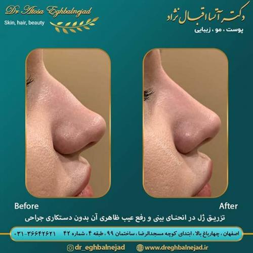 تزریق-ژل-در-انحنای-بینی