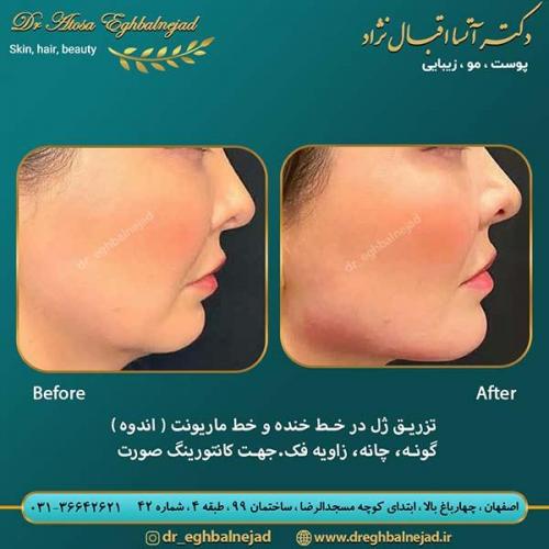 تزریق-ژل-در-خط-خنده-و-خط-ماریونت