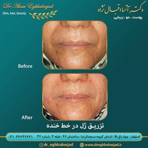 تزریق-ژل-در-خط-خنده