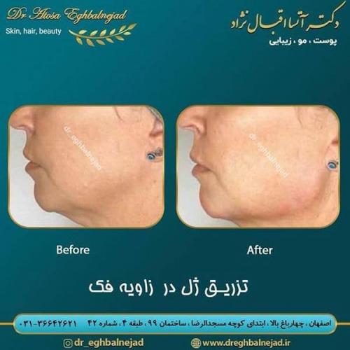 تزریق-ژل-در-زاویه-فک-30