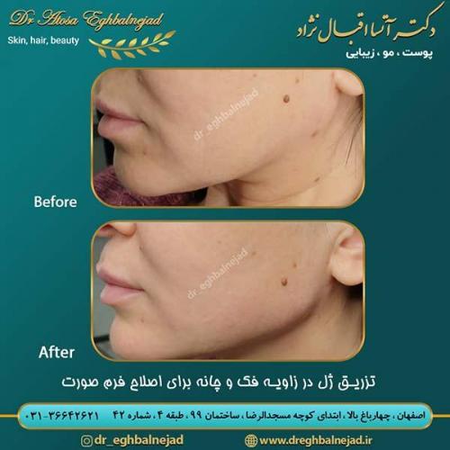 تزریق-ژل-در-زاویه-فک-و-چانه-برای-اصلاح-فرم-صورت