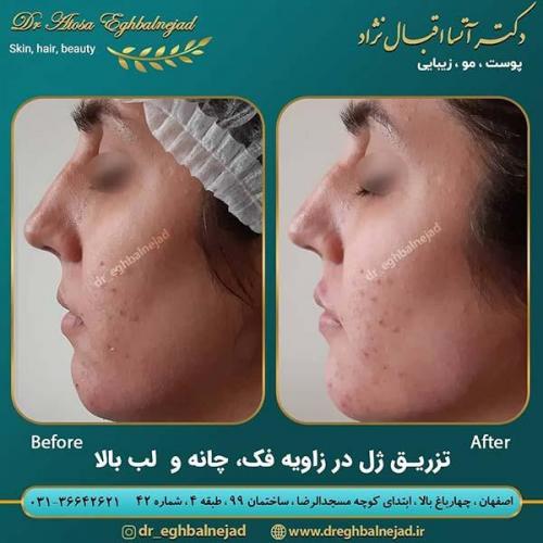 تزریق-ژل-در-زاویه-فک-چانه-و-لب-بالا