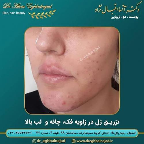 تزریق-ژل-در-ناحیه-فک-چانه-و-لب-بالا-2