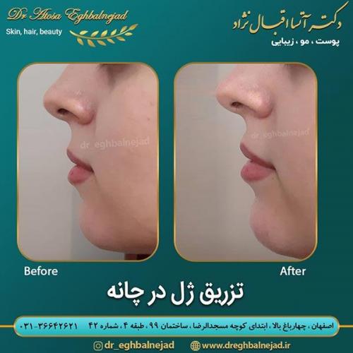 تزریق-ژل-در-چانه
