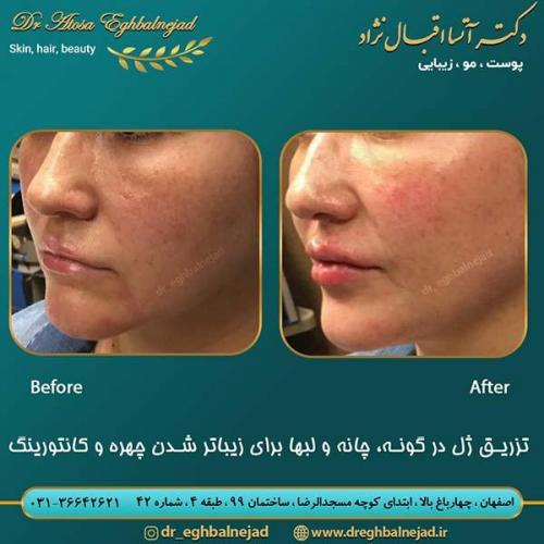 تزریق-ژل-در-گونه-چانه-و-لبها