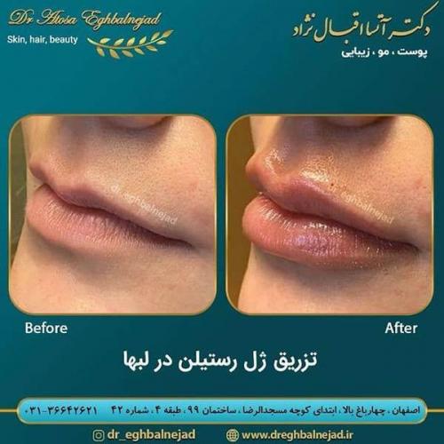 تزریق-ژل-رستیلن-در-لب-ها-20