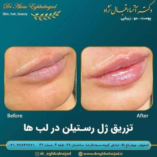 تزریق-ژل-رستیلن-در-لب-ها-21