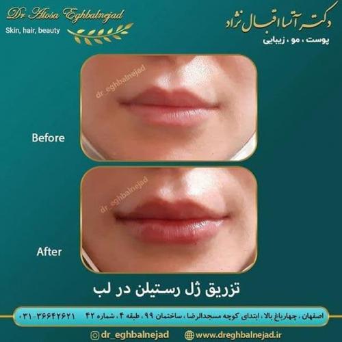 تزریق-ژل-رستیلن-در-لب