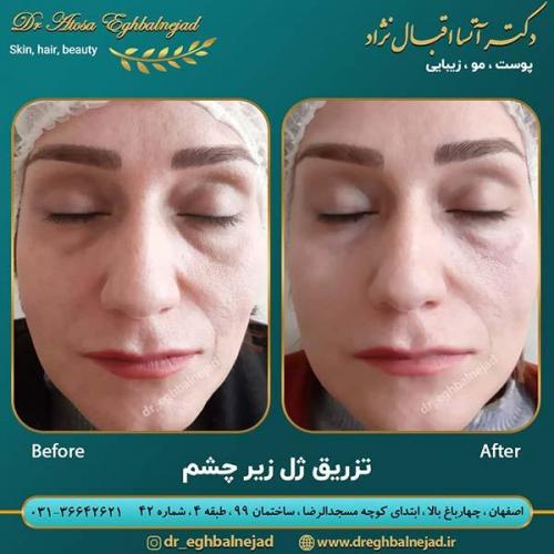 تزریق-ژل-زیر-چشم-1