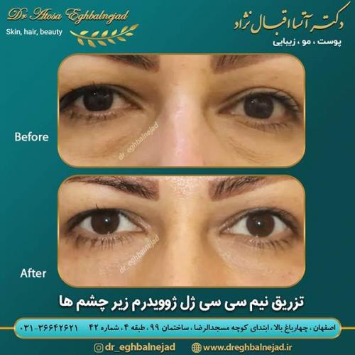 تزریق-ژل-زیر-چشم-2