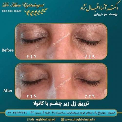 تزریق-ژل-زیر-چشم-با-کانولا
