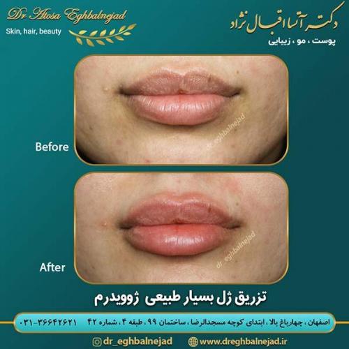 تزریق-ژل-طبیعی-ژوویدرم