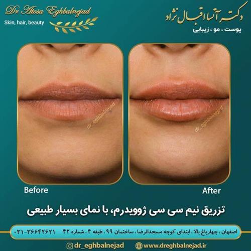 تزریق-ژل-لب--6